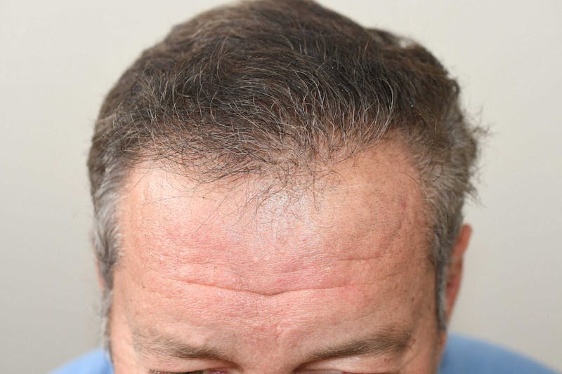 Hair Restoration for Men Before & After Gallery - Patient 368593 - Image 2