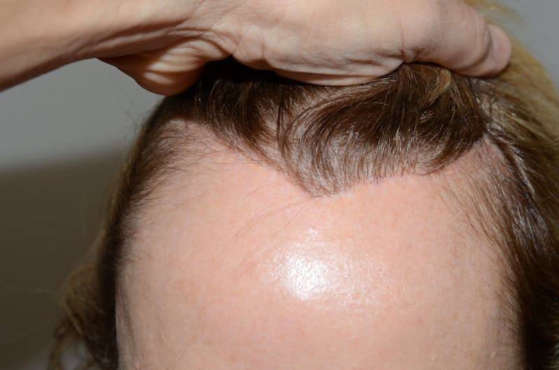 Hair Procedures for Women Before & After Gallery - Patient 542448 - Image 1