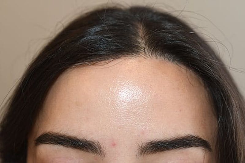 Hairline Lowering Surgery Before & After Gallery - Patient 330985 - Image 2