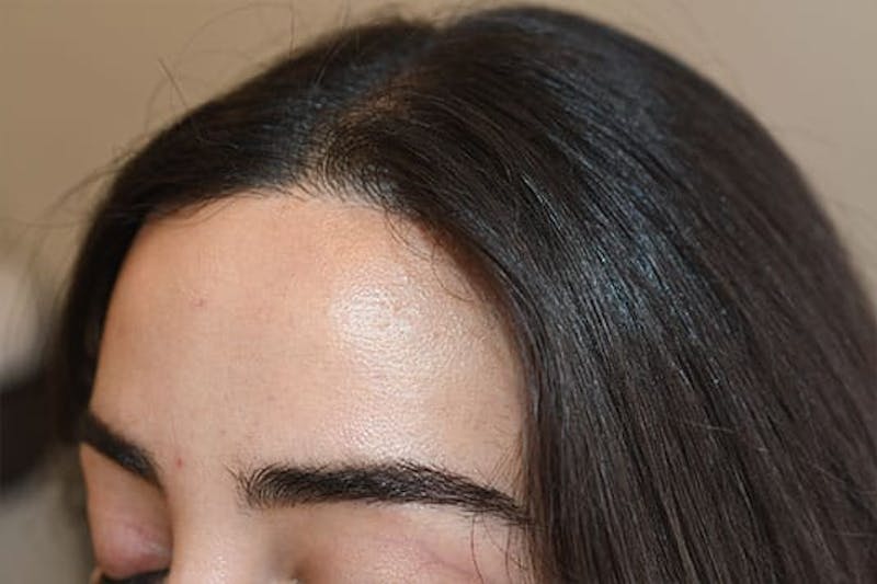 Hairline Lowering Surgery Before & After Gallery - Patient 330985 - Image 4