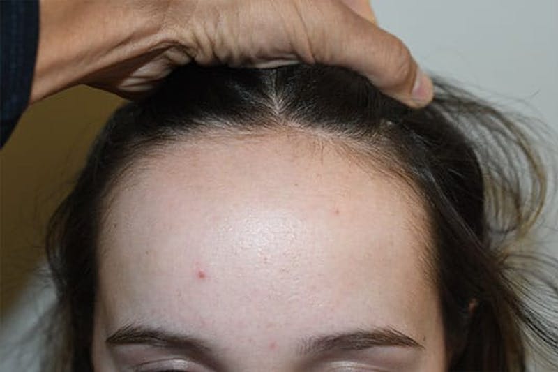 Hairline Lowering Surgery Before & After Gallery - Patient 244056 - Image 1