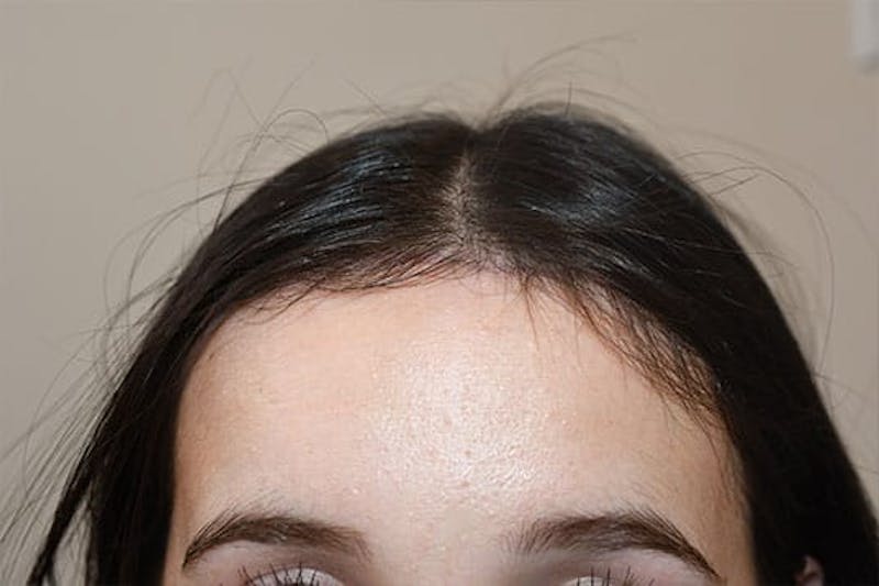 Hairline Lowering Surgery Before & After Gallery - Patient 244056 - Image 2
