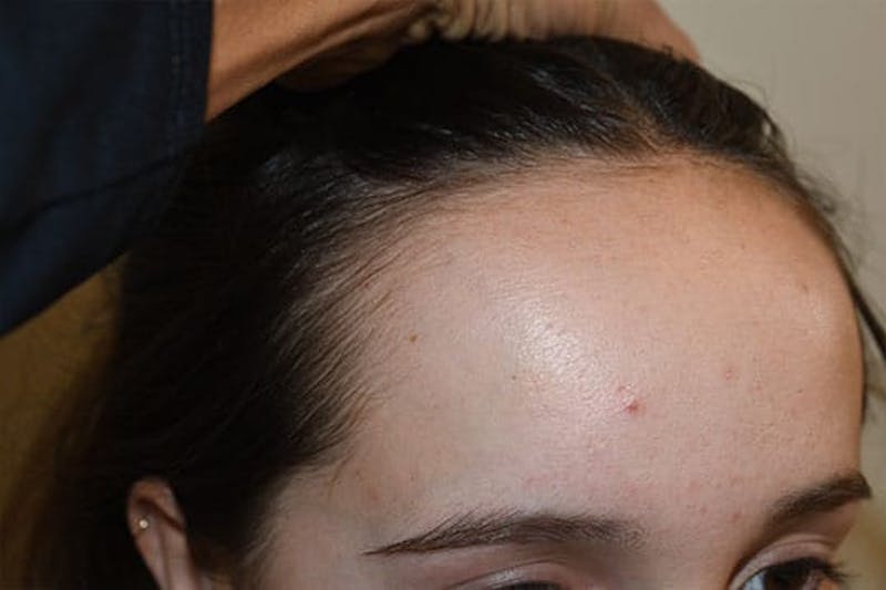 Hairline Lowering Surgery Before & After Gallery - Patient 244056 - Image 3