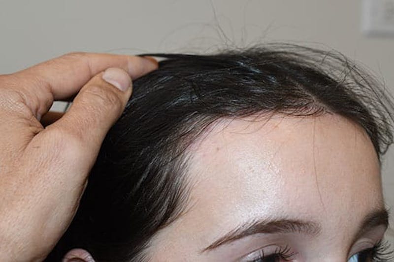 Hairline Lowering Surgery Before & After Gallery - Patient 244056 - Image 4