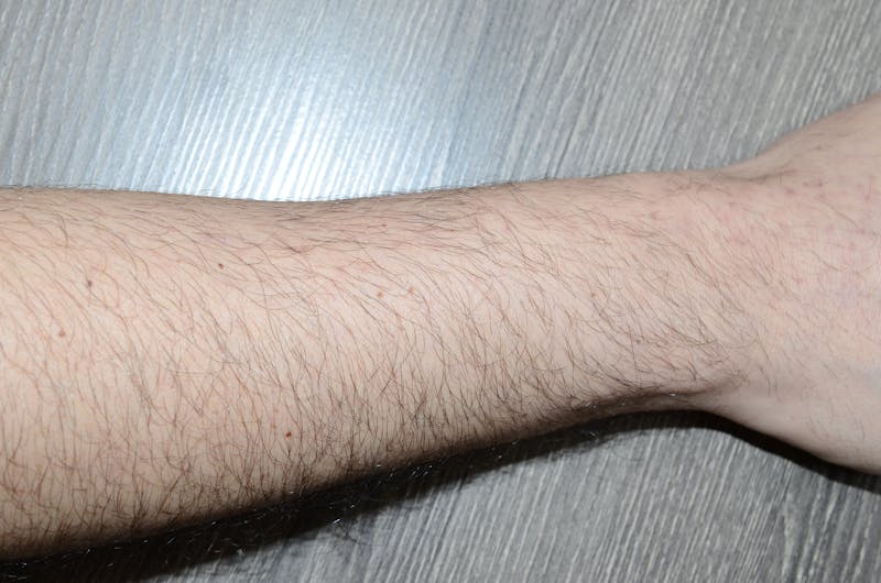 Body Hair Transplants Before & After Gallery - Patient 199591 - Image 2