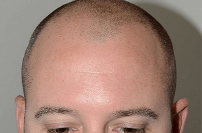 Hair Restoration for Men Before & After Gallery - Patient 162123 - Image 1