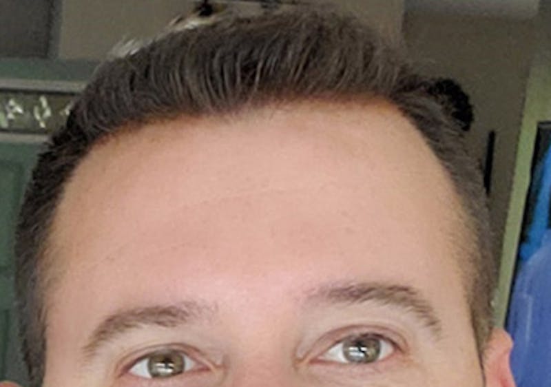 Hair Restoration for Men Before & After Gallery - Patient 162123 - Image 2