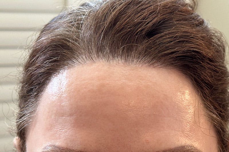 Hair Procedures for Women Before & After Gallery - Patient 186876 - Image 2