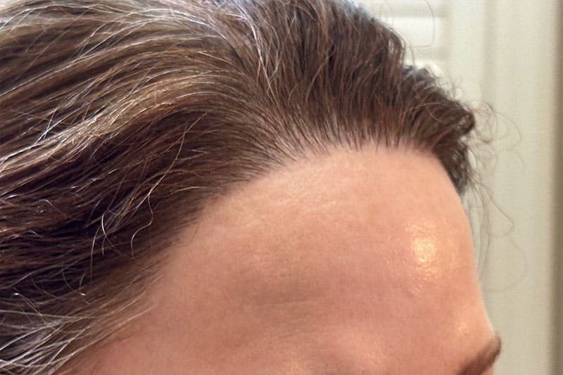 Hair Procedures for Women Before & After Gallery - Patient 186876 - Image 4