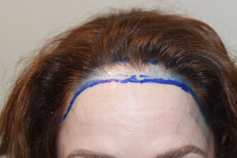 Hair Procedures for Women Before & After Gallery - Patient 186876 - Image 1