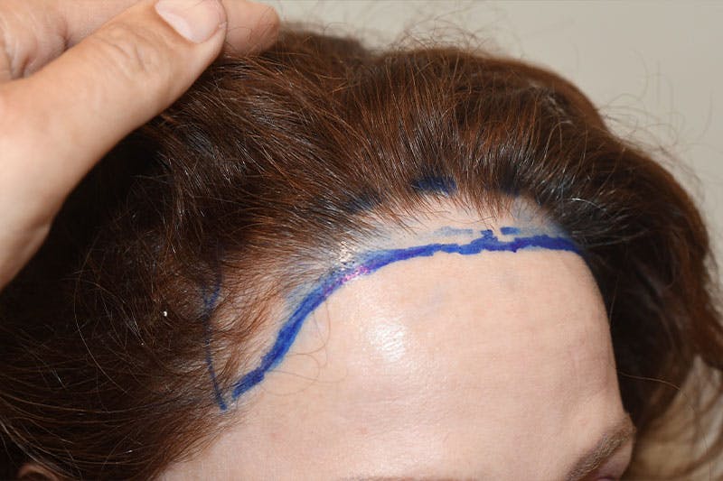 Hair Procedures for Women Before & After Gallery - Patient 186876 - Image 3