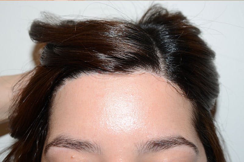 Hairline Lowering Surgery Before & After Gallery - Patient 754753 - Image 2