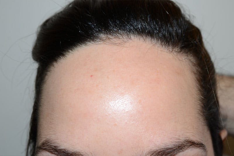 Hairline Lowering Surgery Before & After Gallery - Patient 754753 - Image 1