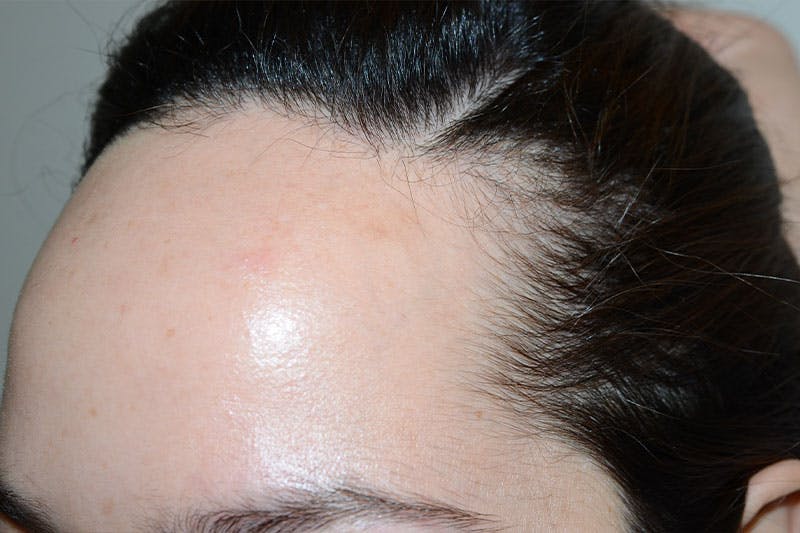 Hairline Lowering Surgery Before & After Gallery - Patient 754753 - Image 3