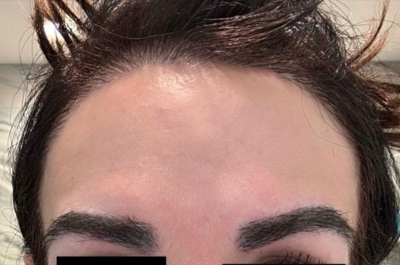 Hair Procedures for Women Before & After Gallery - Patient 179677 - Image 2