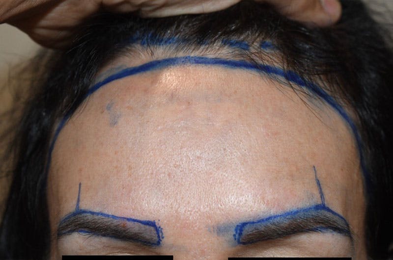 Hair Procedures for Women Before & After Gallery - Patient 179677 - Image 1