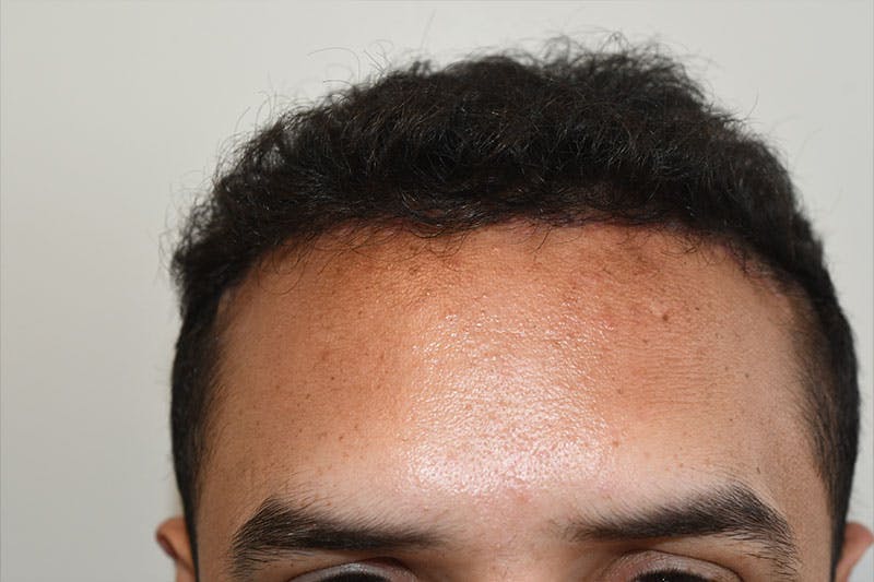 Hairline Lowering Surgery Before & After Gallery - Patient 402697 - Image 2
