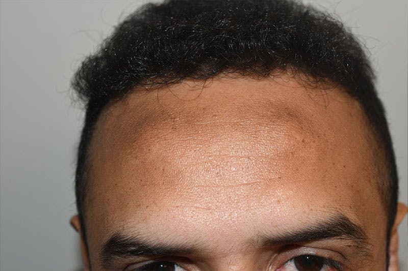 Hairline Lowering Surgery Before & After Gallery - Patient 402697 - Image 1