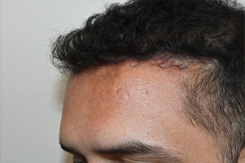 Hairline Lowering Surgery Before & After Gallery - Patient 402697 - Image 4