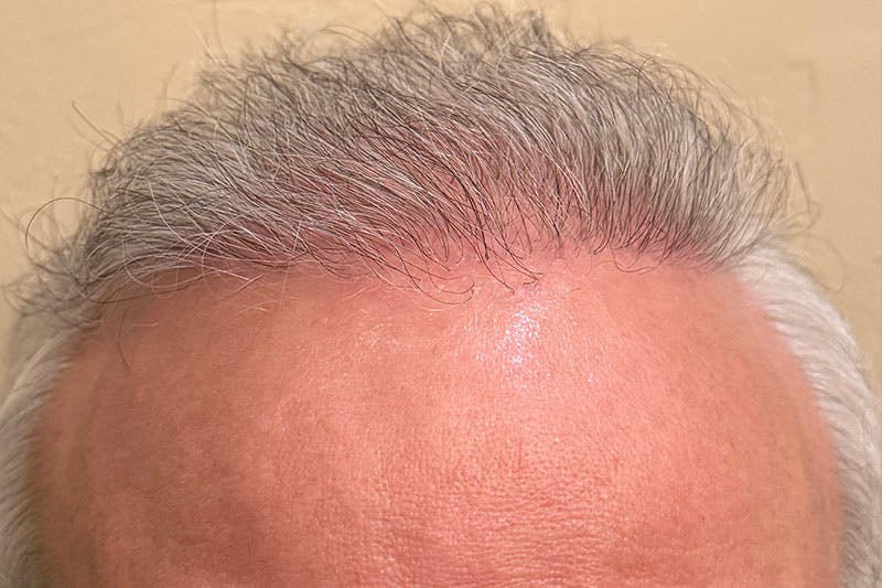 hair restoration