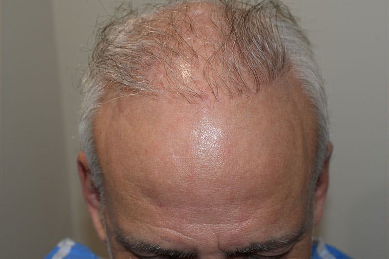 Hair Restoration for Men Before & After Gallery - Patient 214676 - Image 1
