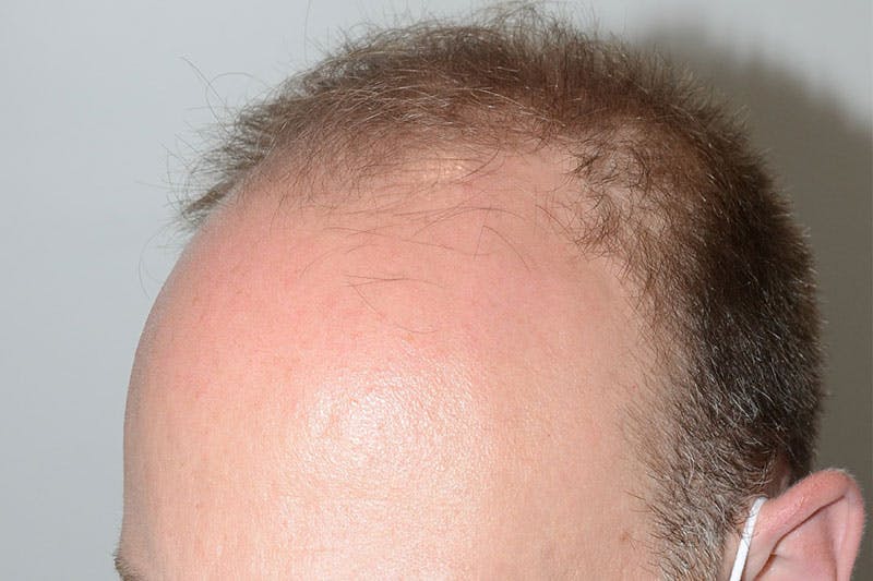 Hair Restoration for Men Before & After Gallery - Patient 305730 - Image 3