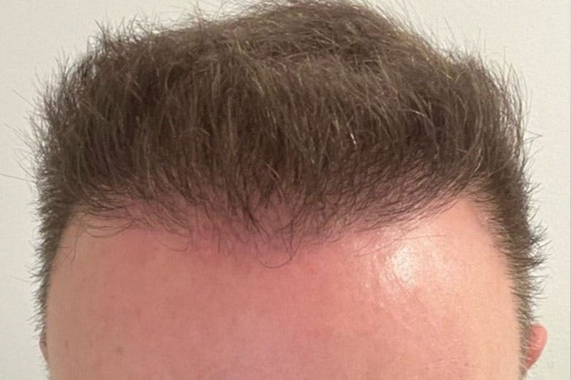 Hair Restoration for Men Before & After Gallery - Patient 305730 - Image 6