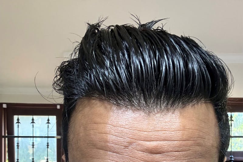 Hair Restoration for Men Before & After Gallery - Patient 319044 - Image 2