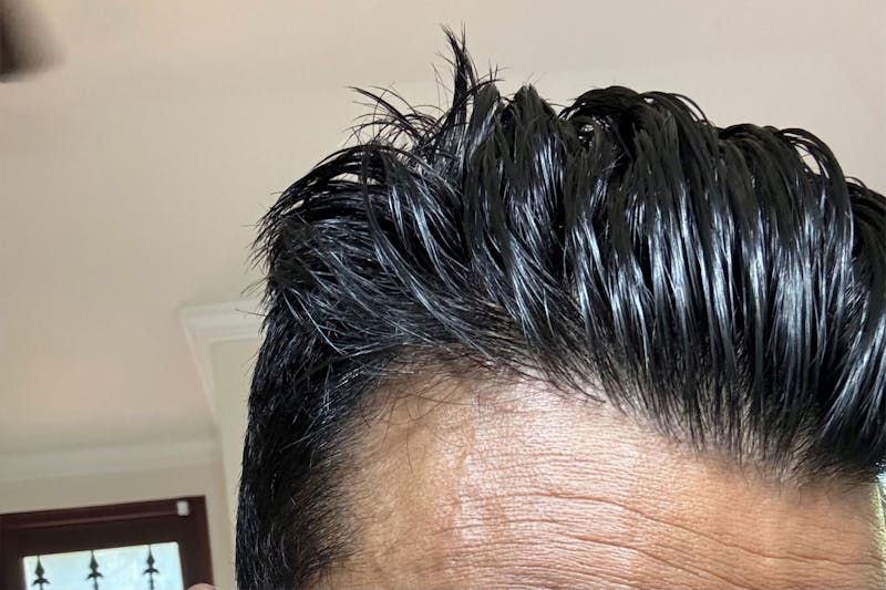 Hair Restoration for Men Before & After Gallery - Patient 319044 - Image 6