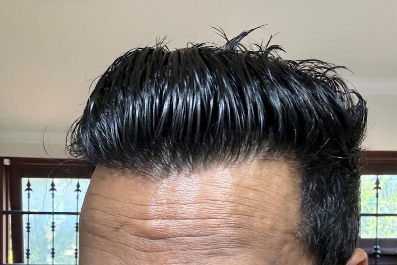 Hair Restoration for Men Before & After Gallery - Patient 319044 - Image 4