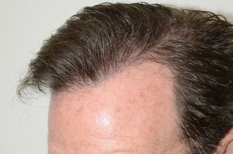 Hair Restoration for Men Before & After Gallery - Patient 261451 - Image 4