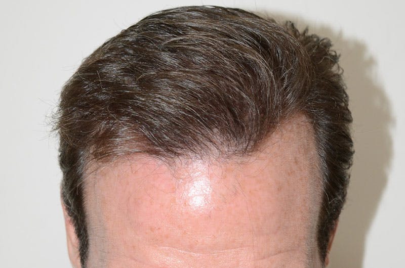Hair Restoration for Men Before & After Gallery - Patient 261451 - Image 6