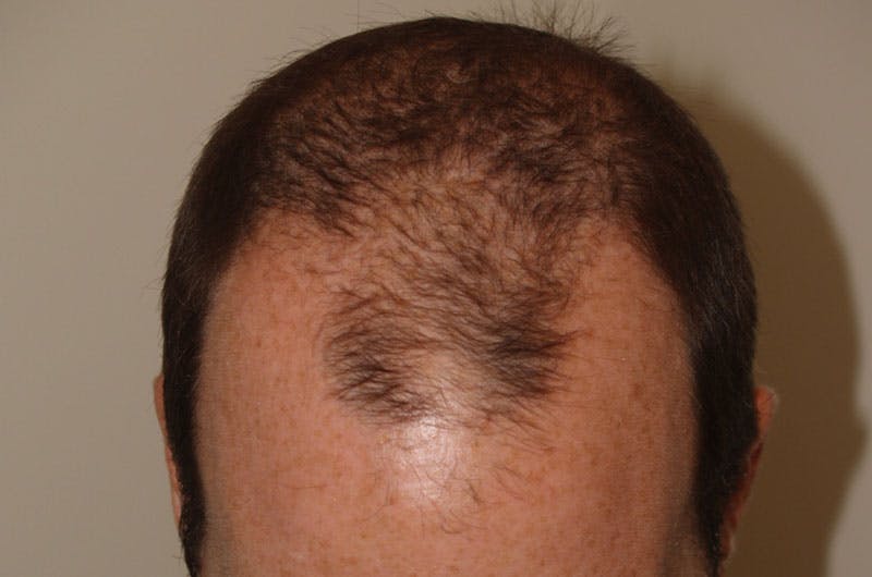 Hair Restoration for Men Before & After Gallery - Patient 261451 - Image 7