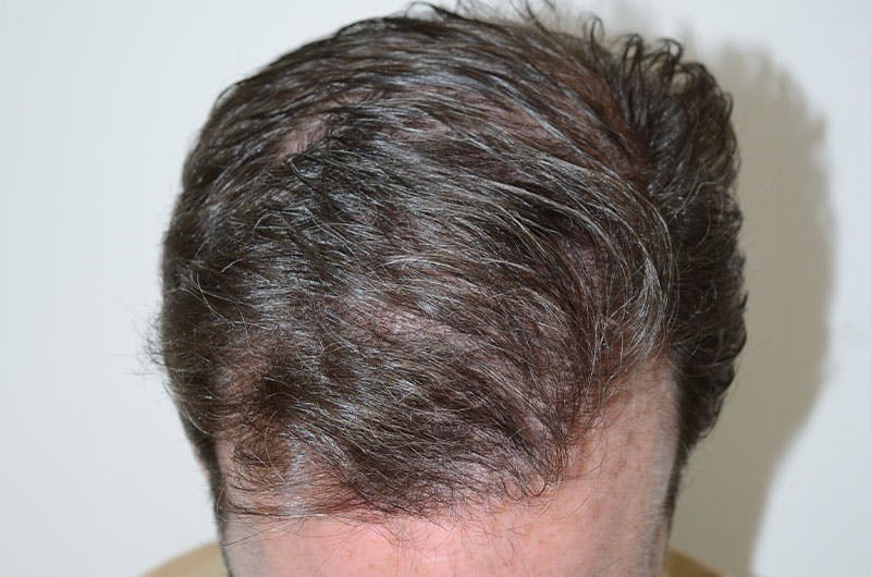 Hair Restoration for Men Before & After Gallery - Patient 261451 - Image 8