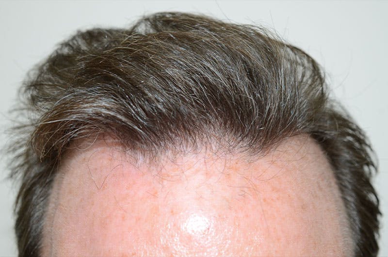 Hair Restoration for Men Before & After Gallery - Patient 261451 - Image 2
