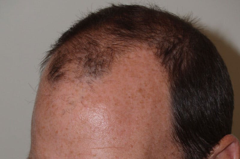 Hair Restoration for Men Before & After Gallery - Patient 261451 - Image 3