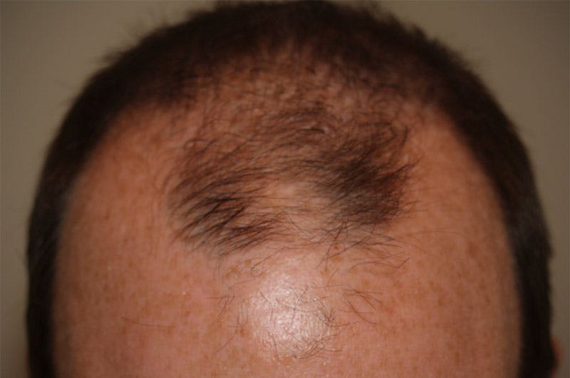 Hair Restoration for Men Before & After Gallery - Patient 261451 - Image 1