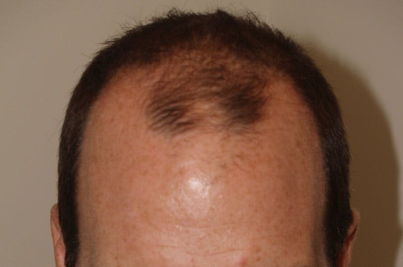 Hair Restoration for Men Before & After Gallery - Patient 261451 - Image 5