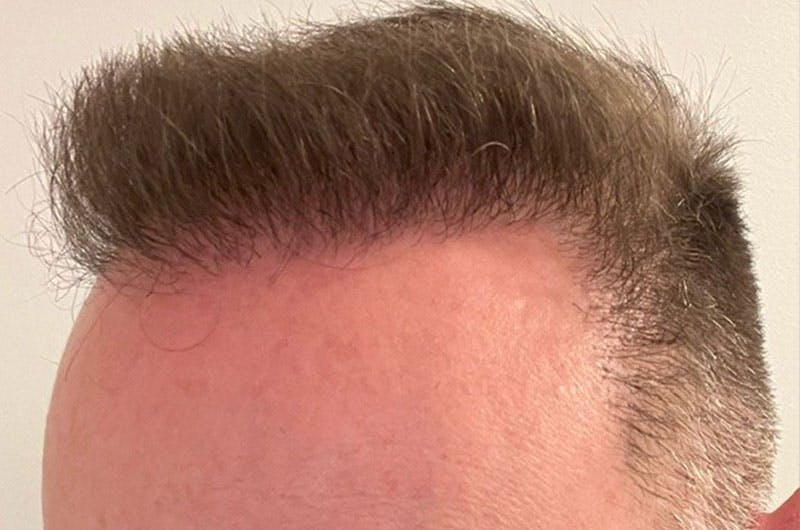Hair Restoration for Men Before & After Gallery - Patient 305730 - Image 6