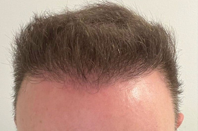 Hair Restoration for Men Before & After Gallery - Patient 305730 - Image 2