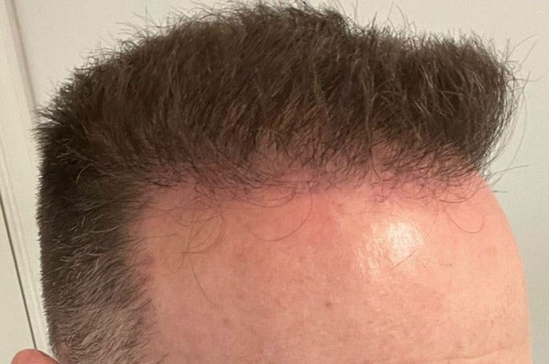 Hair Restoration for Men Before & After Gallery - Patient 305730 - Image 4