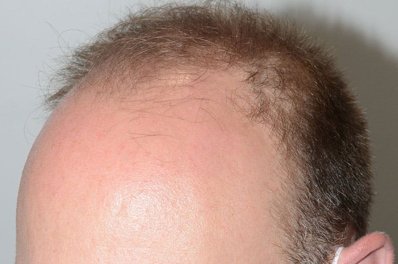 Hair Restoration for Men Before & After Gallery - Patient 305730 - Image 5