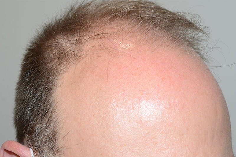 Hair Restoration for Men Before & After Gallery - Patient 305730 - Image 3