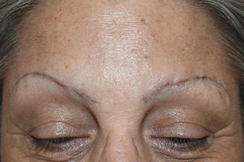 Special Cases Before & After Gallery - Patient 217016 - Image 3