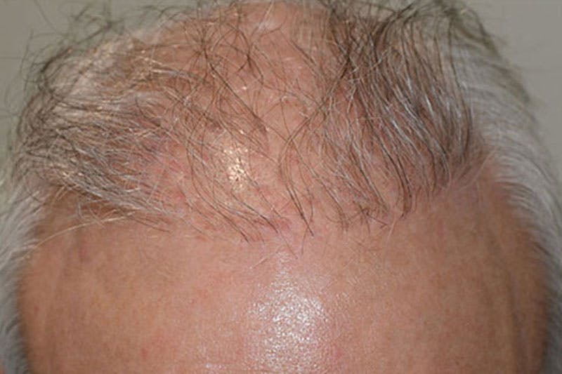 Hair Restoration for Men Before & After Gallery - Patient 214676 - Image 1
