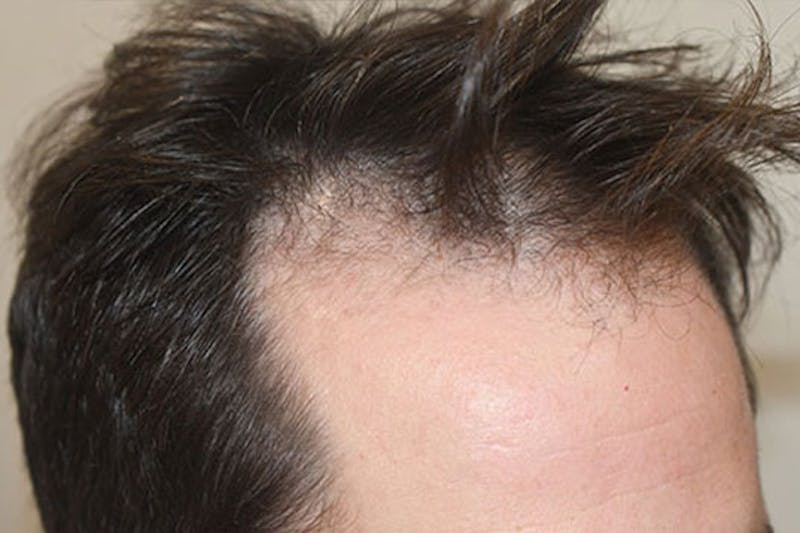 Hair Restoration for Men Before & After Gallery - Patient 387748 - Image 1