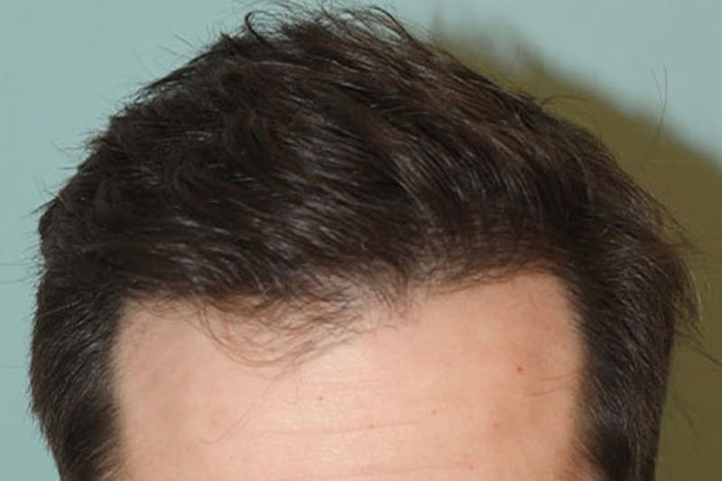 Hair Restoration for Men Before & After Gallery - Patient 387748 - Image 4