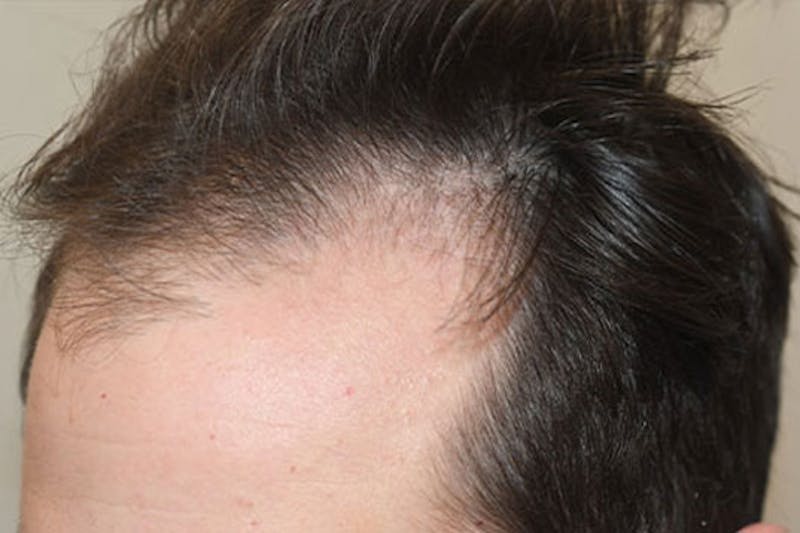 Hair Restoration for Men Before & After Gallery - Patient 387748 - Image 5