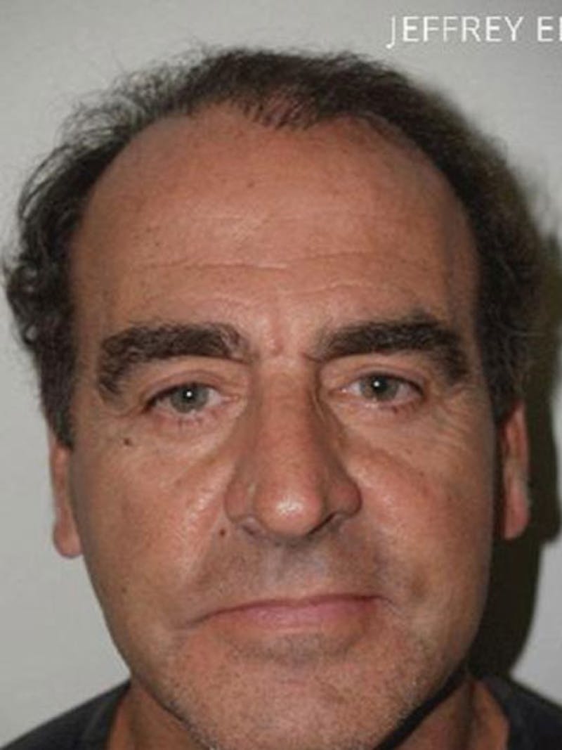 Hair Restoration for Men Before & After Gallery - Patient 109218 - Image 3