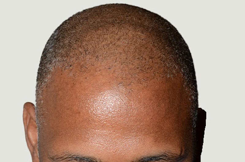 Hair Restoration for Men Before & After Gallery - Patient 309940 - Image 1